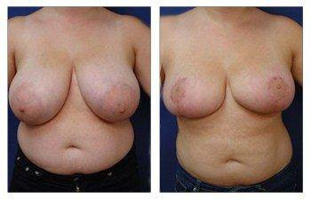 Breast Lift — #SS231