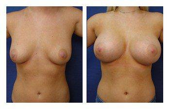 Breast Augmentation — #SS236