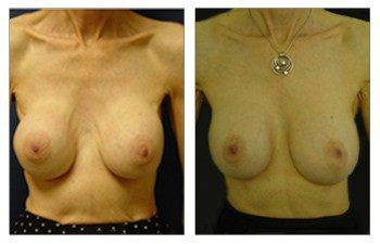 Breast Augmentation Revision — #SS243