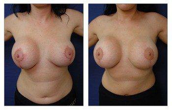 Breast Augmentation Revision — #SS245