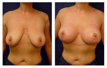 Breast Lift — #SS253