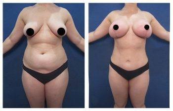 Mommy Makeover – Upper Belly Fullness