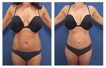 Mini Tummy Tuck + Lipo Revision — #SS058