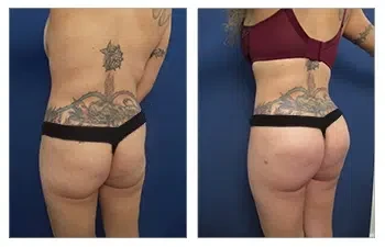 Buttock Implants — #SS136