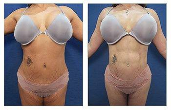 HD Liposuction + Abdominal Etching — #SS092
