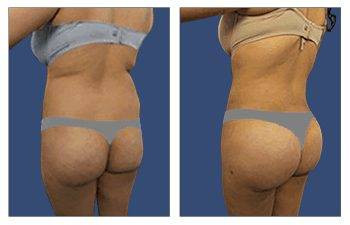 HD Liposuction + Fat Transfer — #SS131
