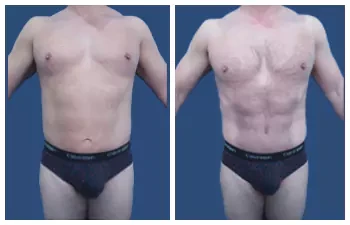 HD Lipo 360 — #SS099