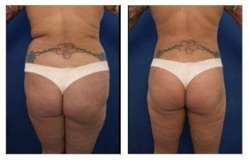HD Liposuction + BBL — #SS046