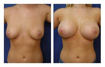Breast Augmentation Revision — #SS372