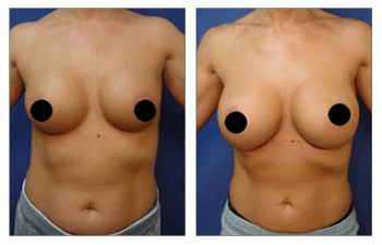 Breast Augmentation Revision — #SS375