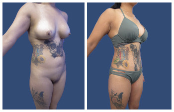 HD Lipo 360 — #SS360