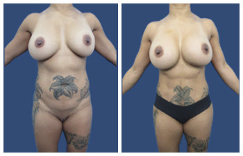 Tummy Tuck + HD Liposuction — #SS361