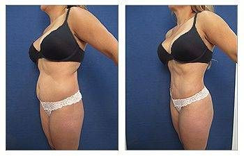 HD Liposuction + Mini Tummy Tuck — #SS079