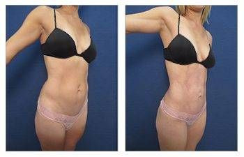 HD Liposuction + Mini Tummy Tuck — #SS080