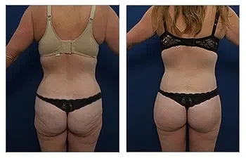 HD Liposuction + BBL — #SS137