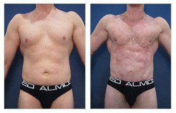 HD Liposuction + Mini Tummy Tuck — #SS095