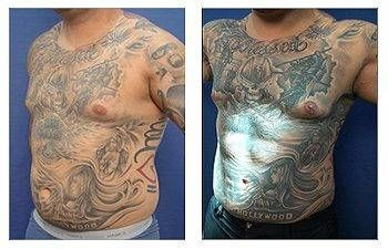 HD Liposuction + Abdominal Etching — #SS093
