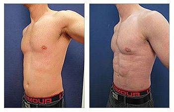Liposuction — #SS096