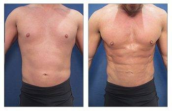 Abdominal Etching — #SS086