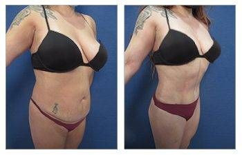 HD Lipo 360 — #SS112