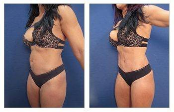 HD Liposuction + Renuvion — #SS011