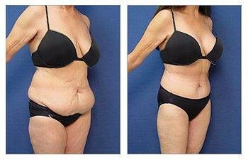 Breast Surgery + Tummy Tuck — #SS061