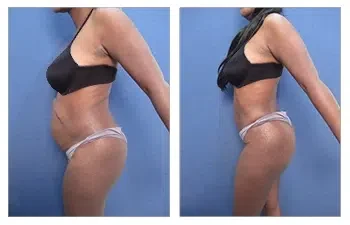 Tummy Tuck — #SS062