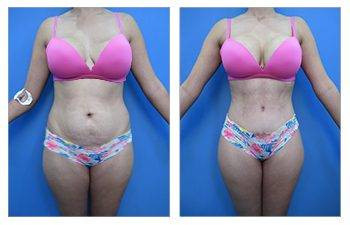 Lipo + Tummy Tuck Combination