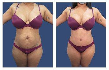 Tummy Tuck — #SS054