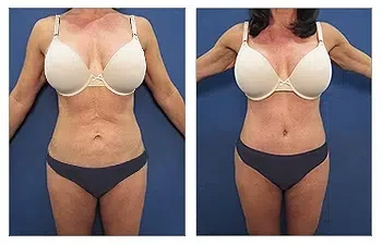Liposuction — #SS027