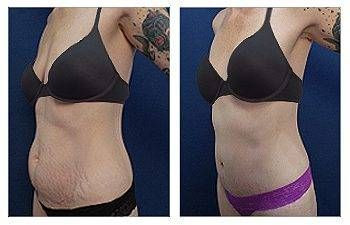 Tummy Tuck + Breast Surgery — #SS063