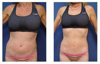 Mini Tummy Tuck — #SS069