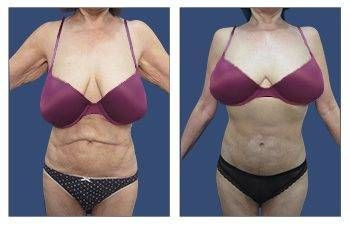Tummy Tuck — #SS060