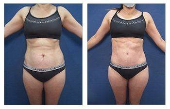 Tummy Tuck — #SS052