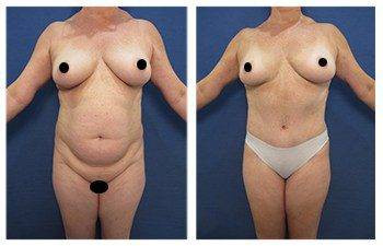 High Definition Liposuction — #SS281