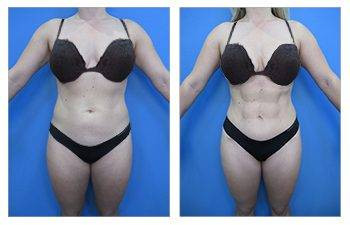 Awake Liposuction — #SS012