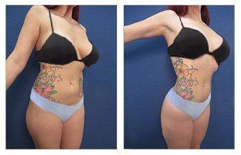 HD Liposuction + BBL — #SS005