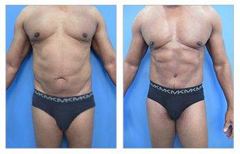 HD Liposuction — #SS083