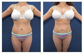 Mini Tummy Tuck — #SS075