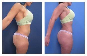 360 Liposuction Results 360 Liposuction Results