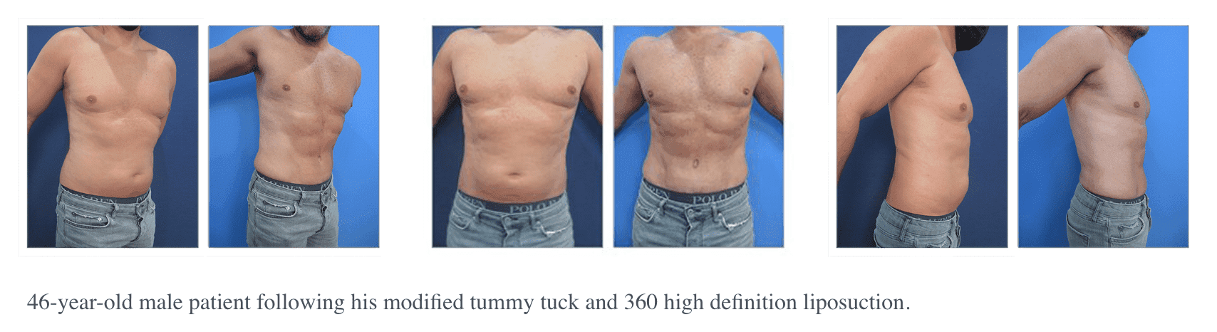 360 Tummy Tuck