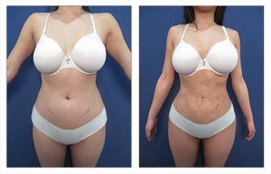4D Liposuction 4D Liposuction