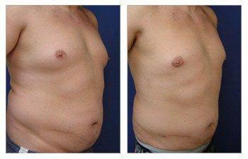 Gynecomastia — #SS207