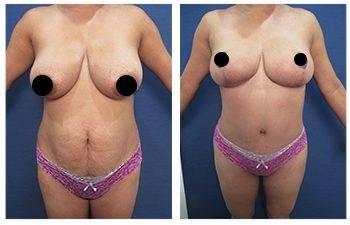 A woman's breast before and after Correct Diastasis Recti surgery. A woman's breast before and after Correct Diastasis Recti surgery.
