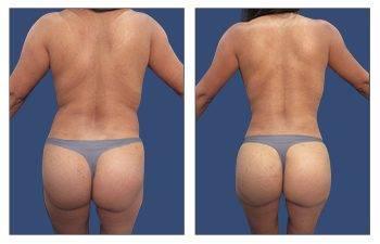 Get free before and after pictures of a woman's bbl buttlift. Get free before and after pictures of a woman's bbl buttlift.