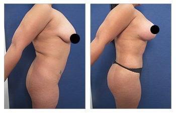 Before and after photos of a tummy tuck.