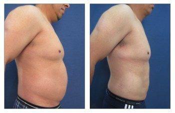 Advantages of Renuvion versus BodyTite