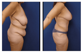 Plastic Surgery After Weight Loss Plastic Surgery After Weight Loss