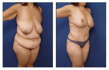 Plastic Surgery After Weight Loss Plastic Surgery After Weight Loss