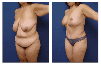 Plastic Surgery After Weight Loss Plastic Surgery After Weight Loss